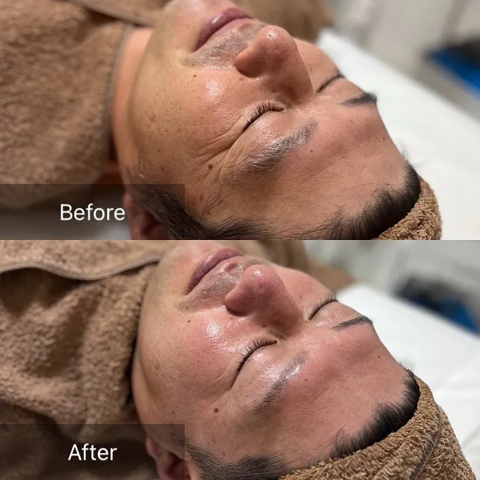 men's facial💆🏼‍♂️